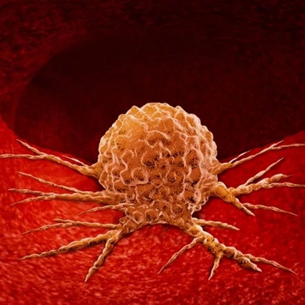 Tumour-(Oncology)--siteimage