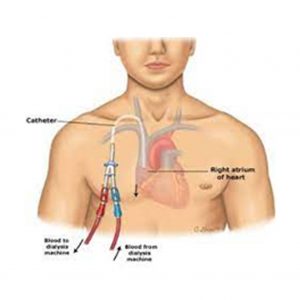 Venous-access-catheter1