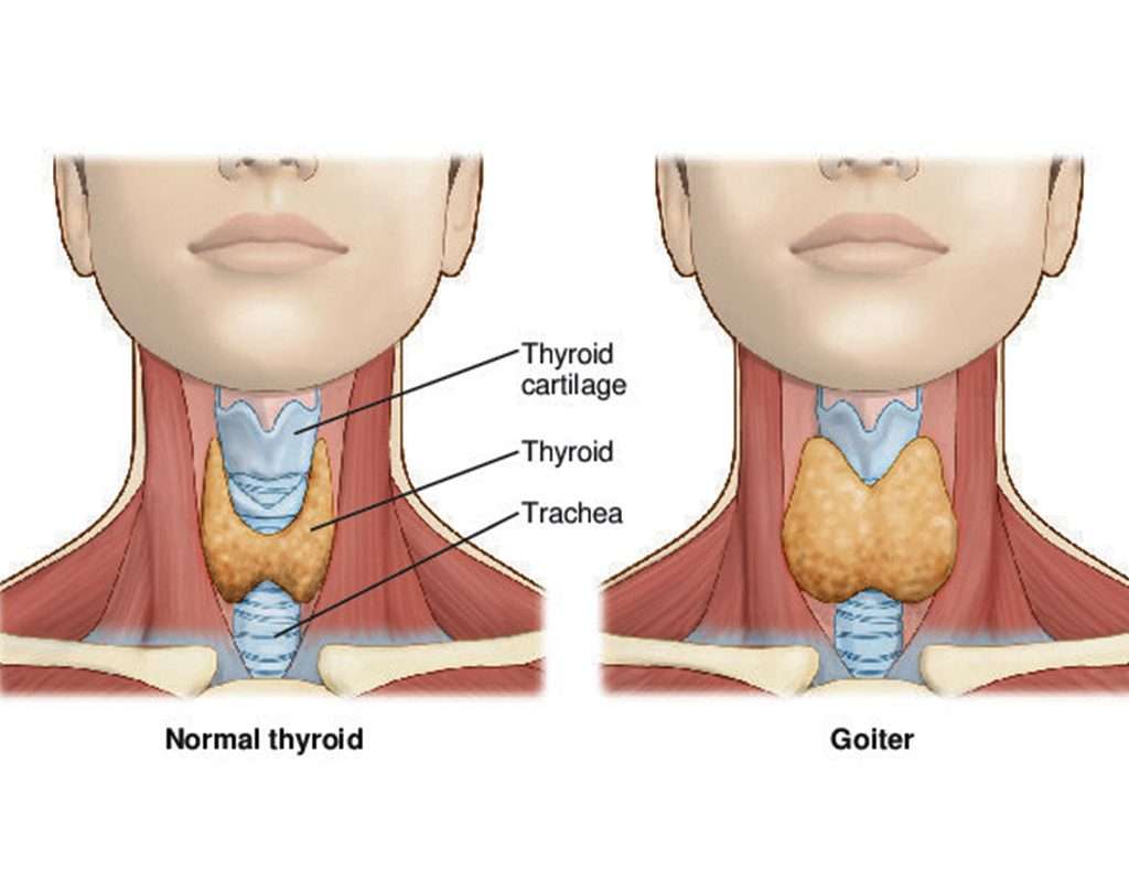 Thyroid-goitre