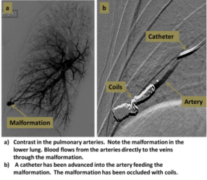 Pva Embolization Rmm Pulmonary arteriovenous malformation embolisation - Dr Karthikeyan ...