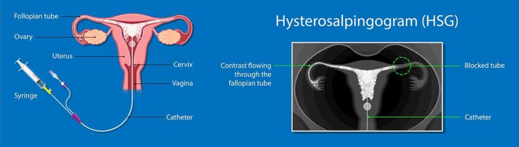 Fallopian Injection Fallopian tube recanalization for infertility - Dr Karthikeyan Damodharan